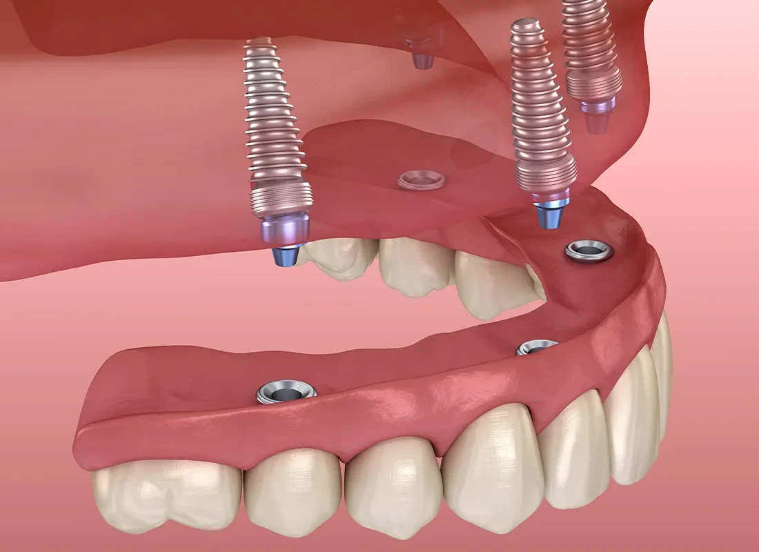 What’s The Most Natural-Looking Tooth Replacement Option?