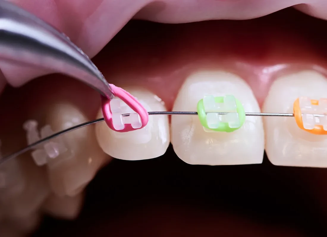 Fastbraces