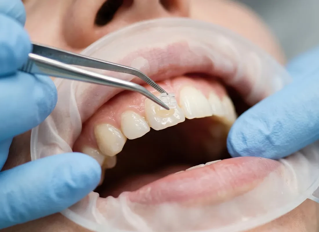 Dental Bonding at Muse Dental Studio