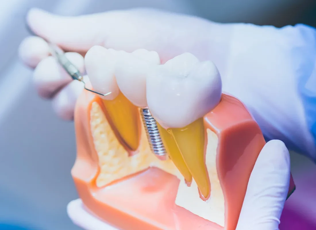 Dental Implants