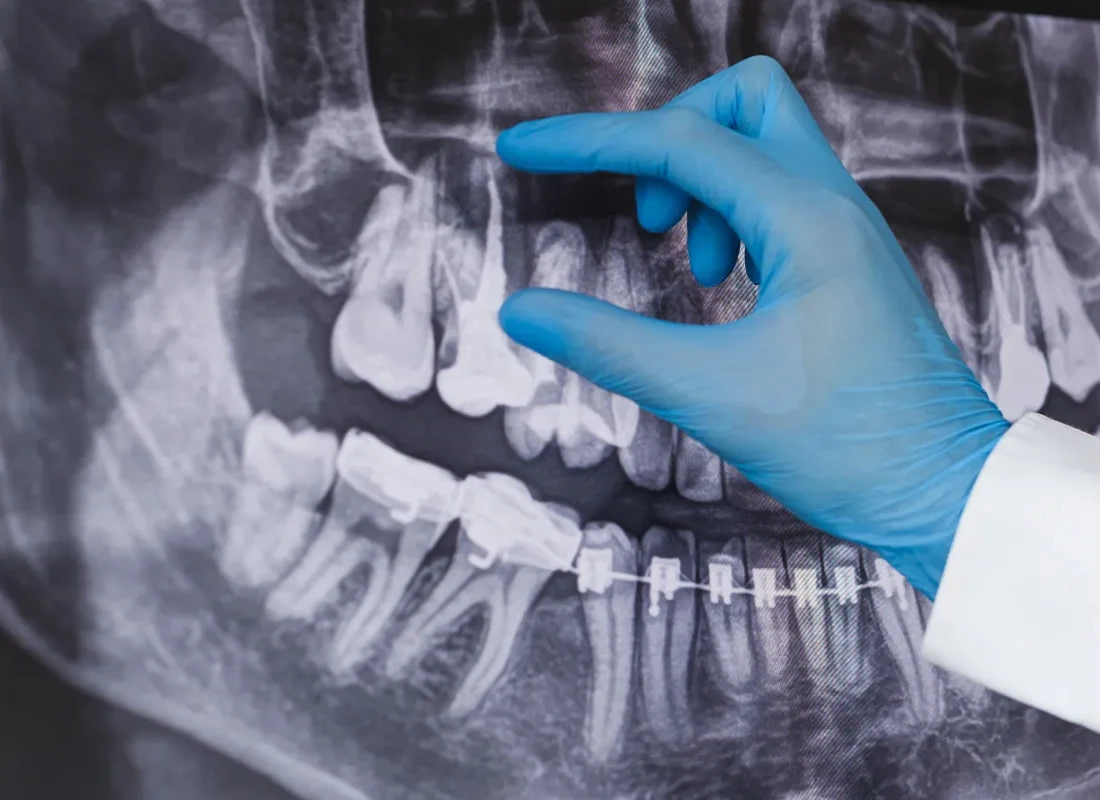 Root Canal