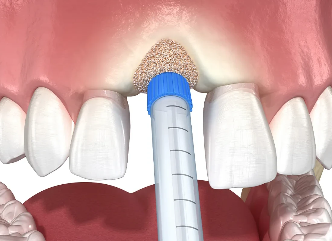 Sinus Lift at Muse Dental Studio