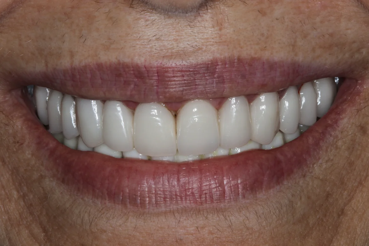 After — real smile transformation at Muse Dental Studio