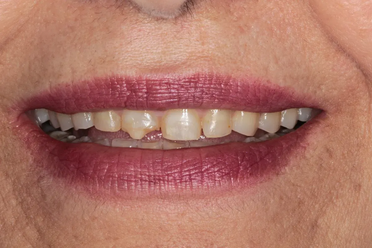 Before — real smile transformation at Muse Dental Studio