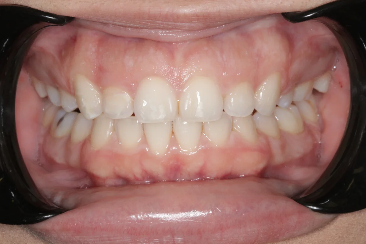 After — real smile transformation at Muse Dental Studio