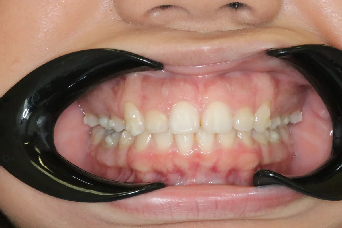 Before — real smile transformation at Muse Dental Studio