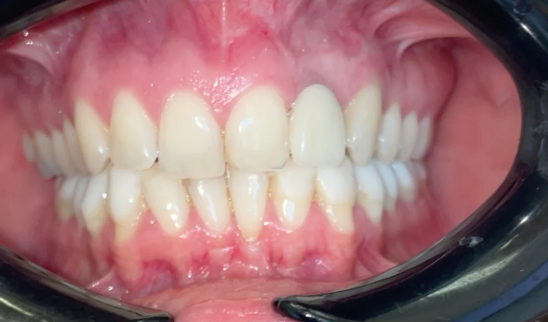 After — real smile transformation at Muse Dental Studio