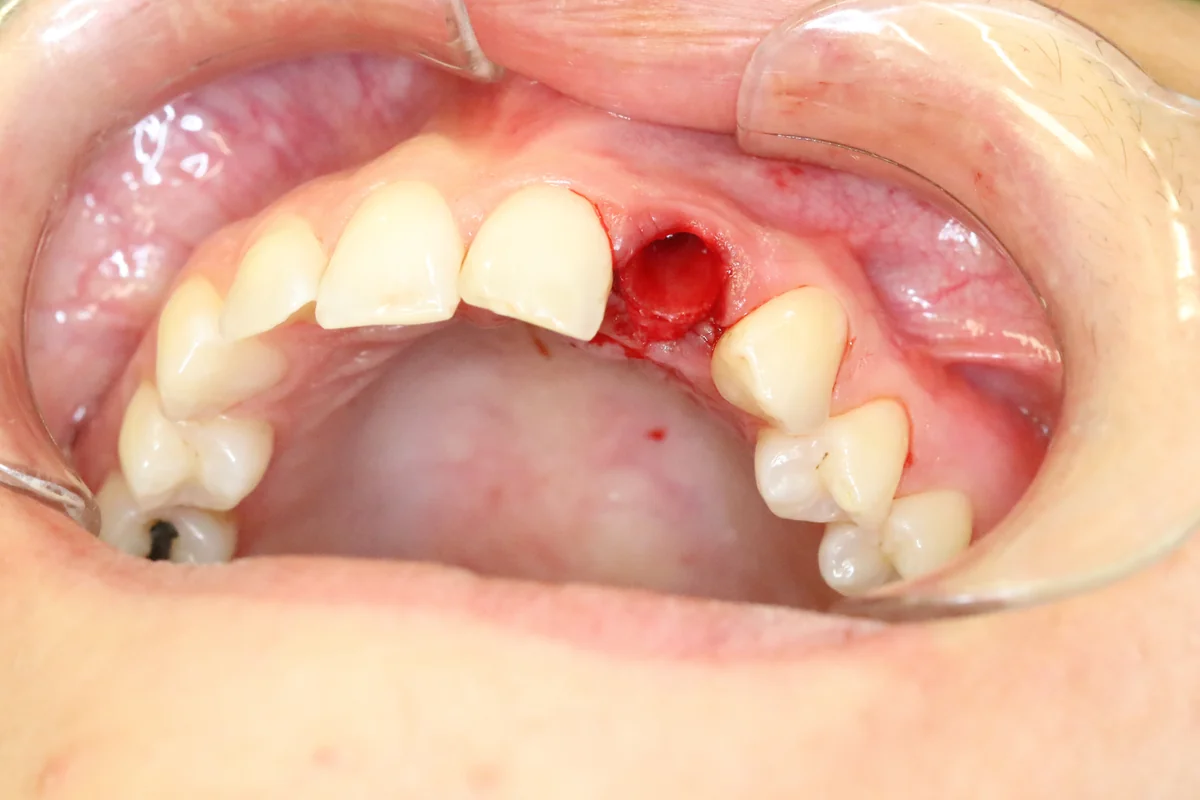 Before — real smile transformation at Muse Dental Studio