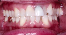 Before — real smile transformation at Muse Dental Studio