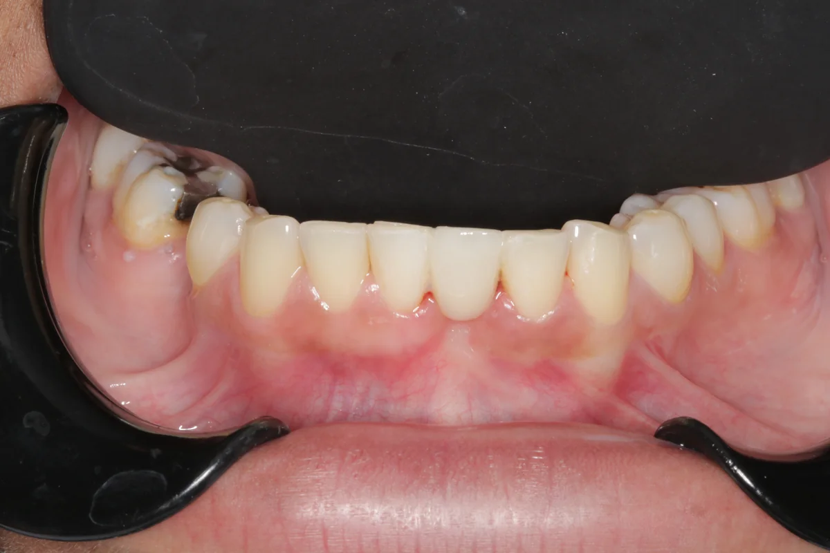After — real smile transformation at Muse Dental Studio