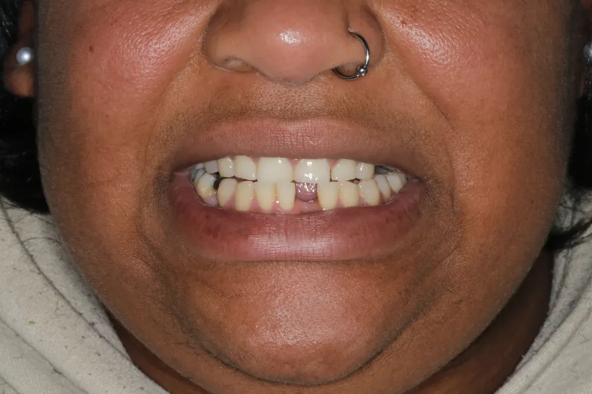 Before — real smile transformation at Muse Dental Studio