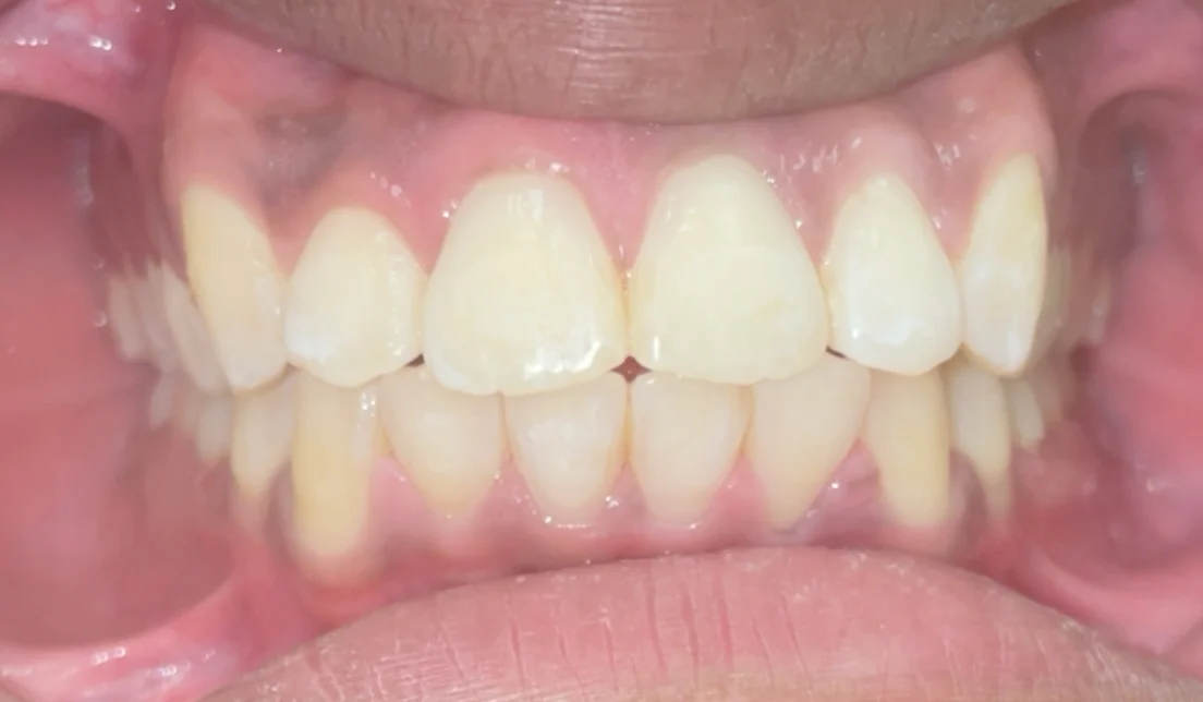 After — real smile transformation at Muse Dental Studio