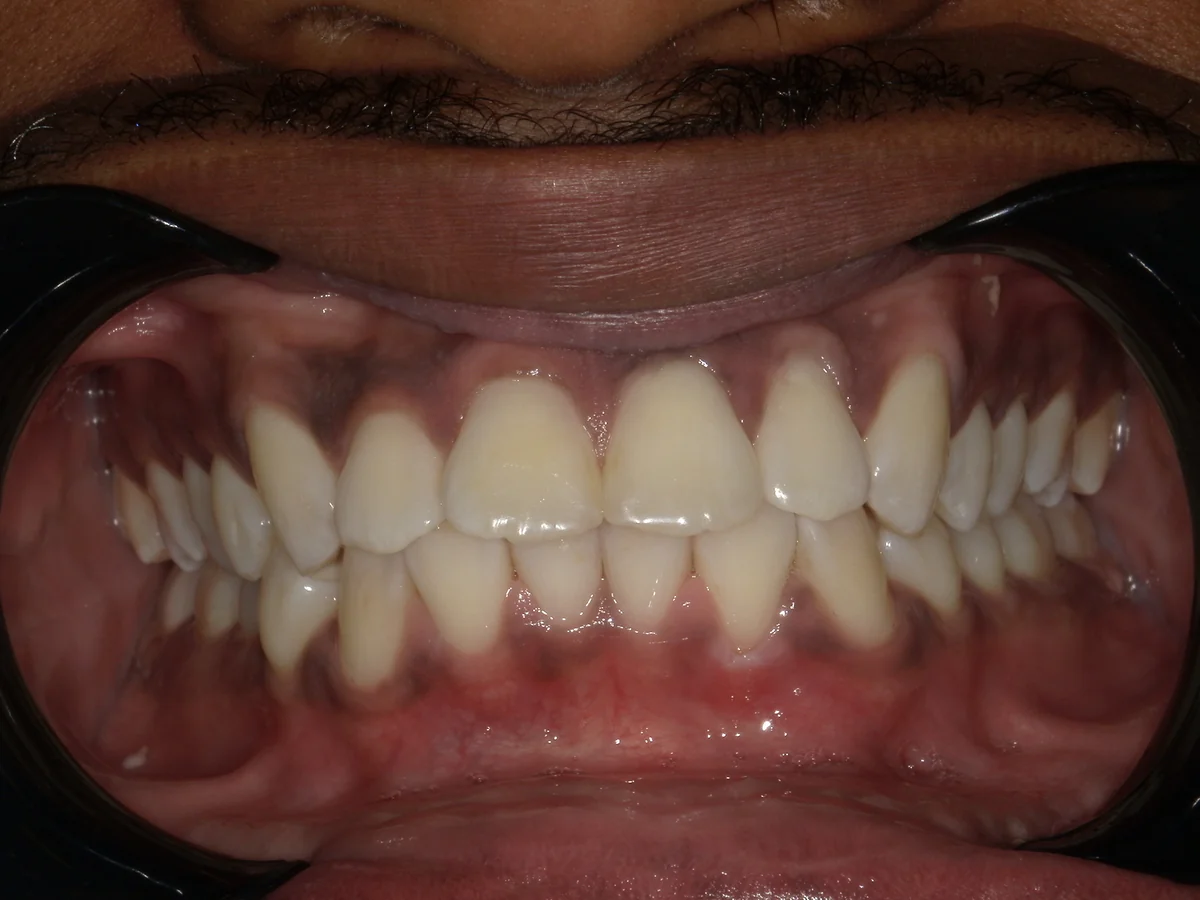 Before — real smile transformation at Muse Dental Studio