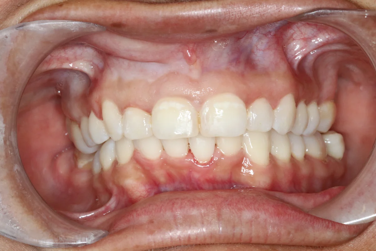 After — real smile transformation at Muse Dental Studio