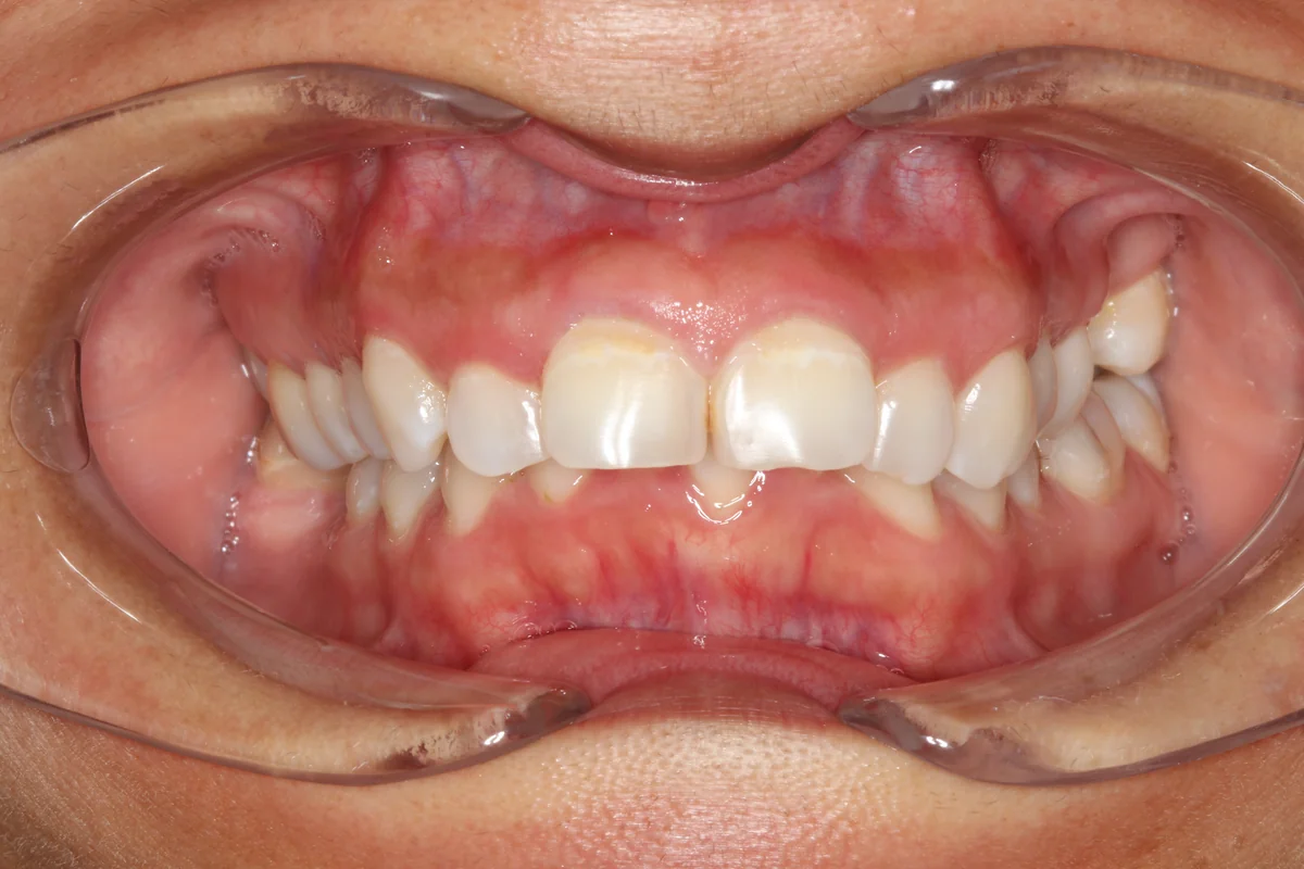 Before — real smile transformation at Muse Dental Studio