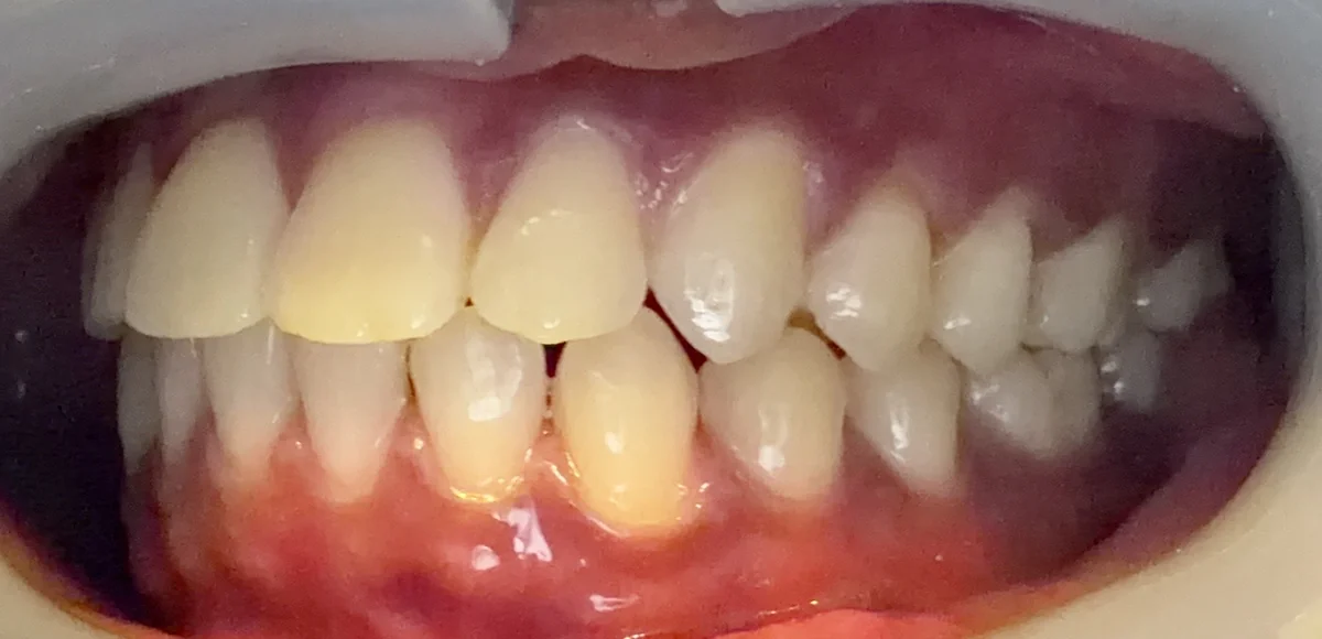 After — real smile transformation at Muse Dental Studio