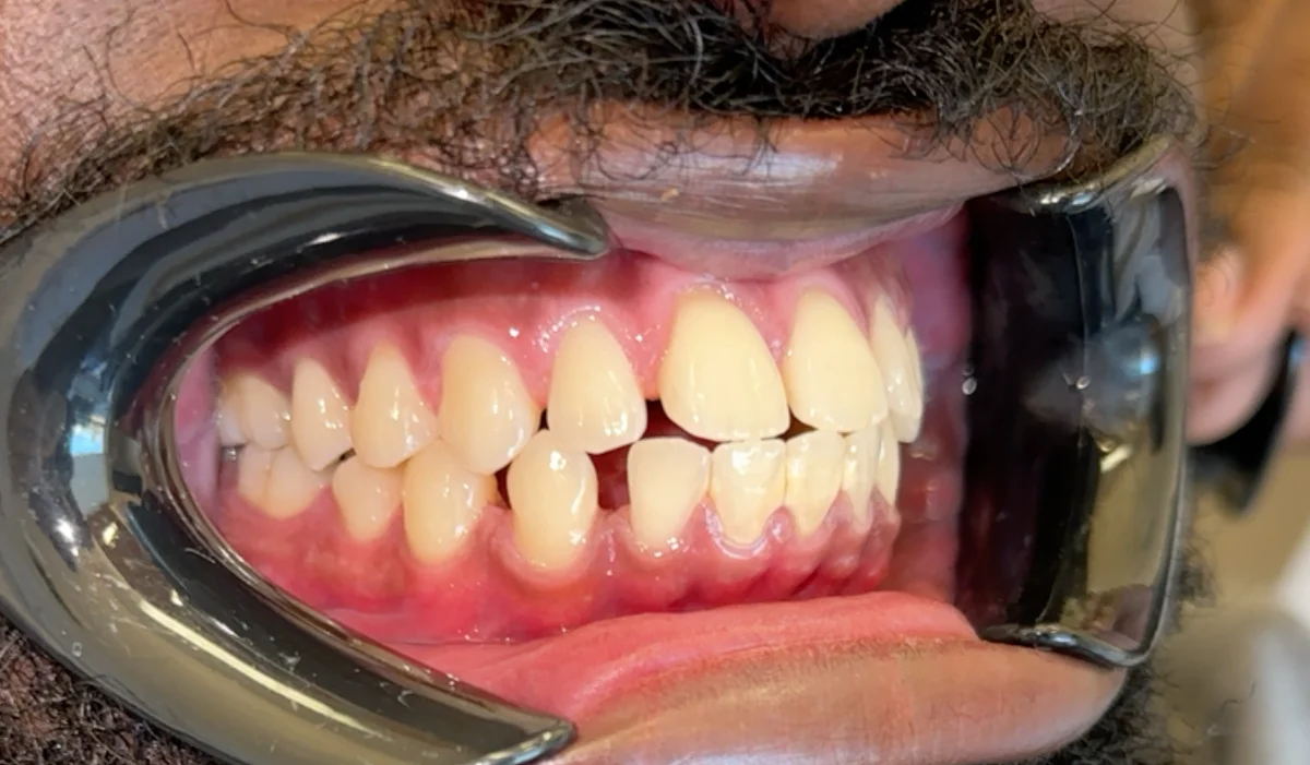 Before — real smile transformation at Muse Dental Studio