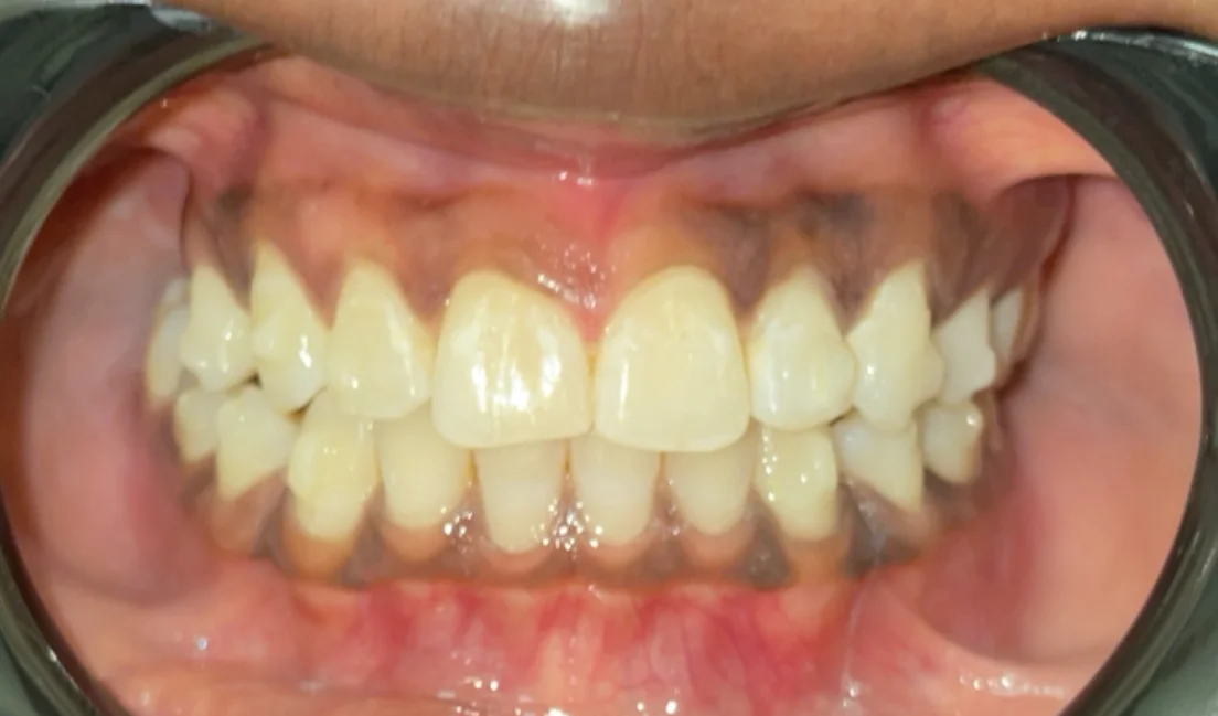 After — real smile transformation at Muse Dental Studio