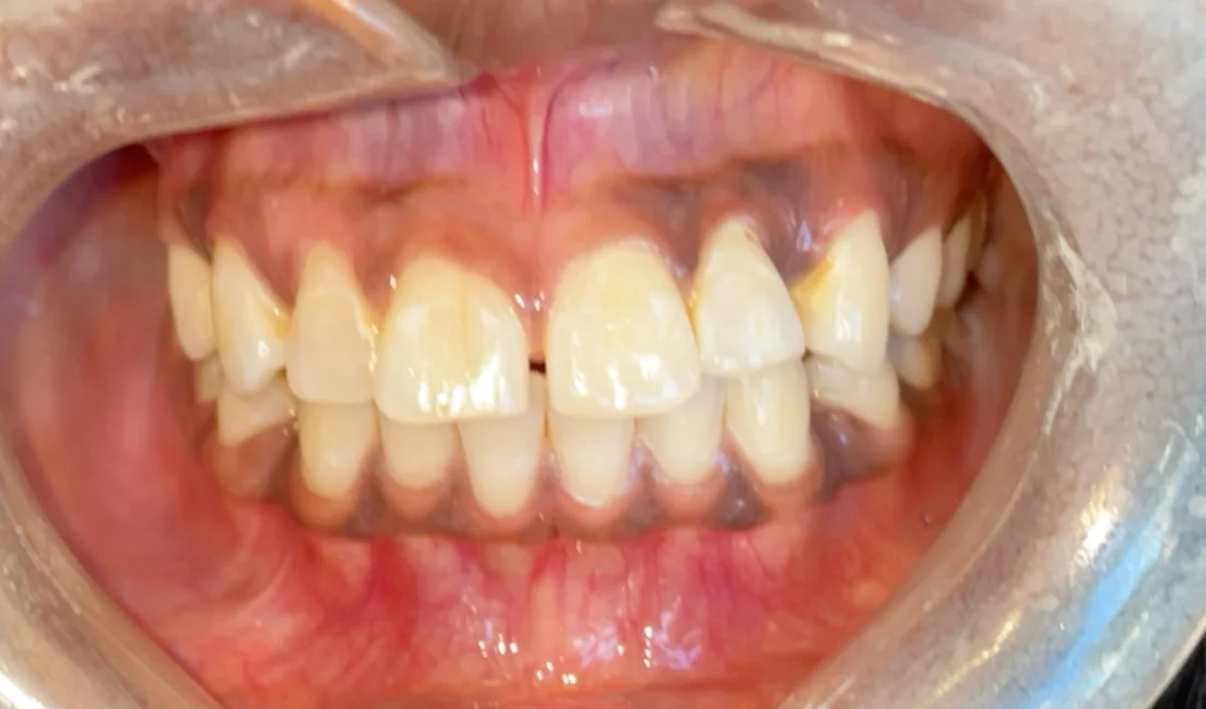 Before — real smile transformation at Muse Dental Studio