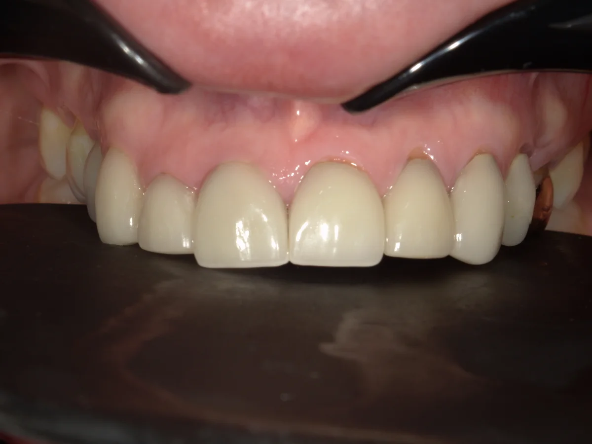 Before — real smile transformation at Muse Dental Studio