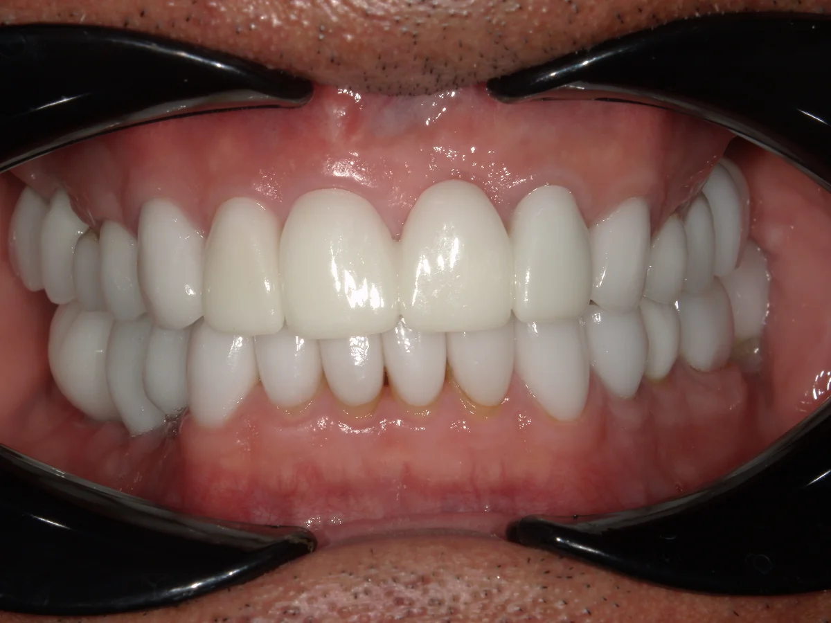 After — real smile transformation at Muse Dental Studio