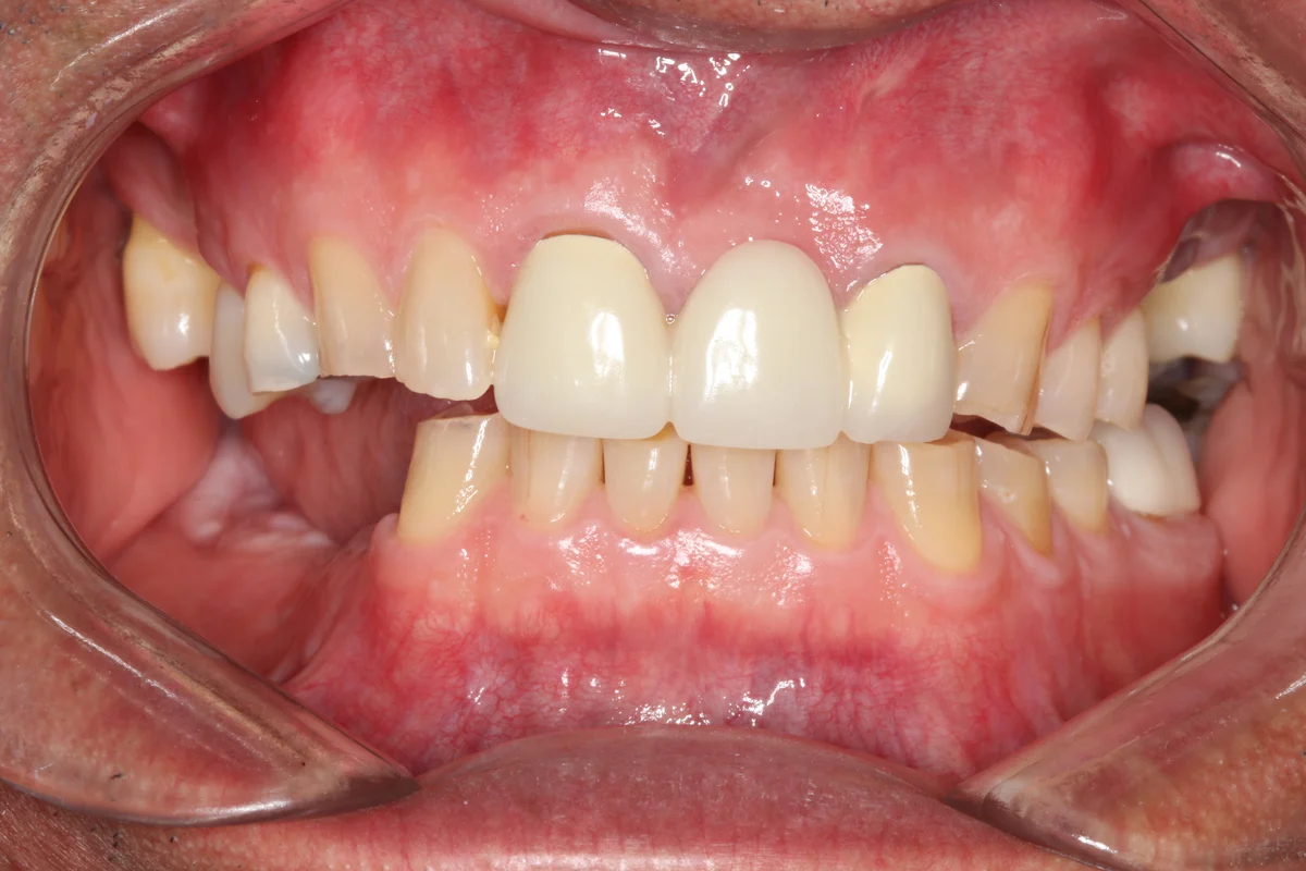 Before — real smile transformation at Muse Dental Studio