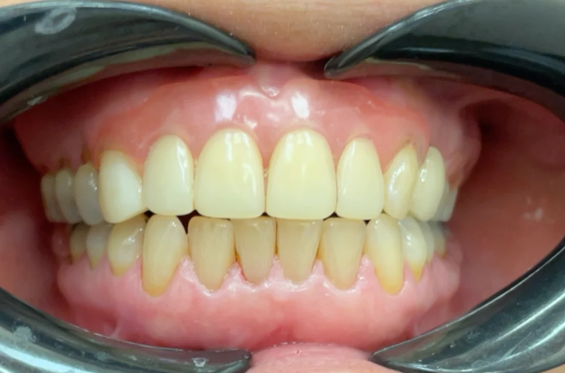 After — real smile transformation at Muse Dental Studio