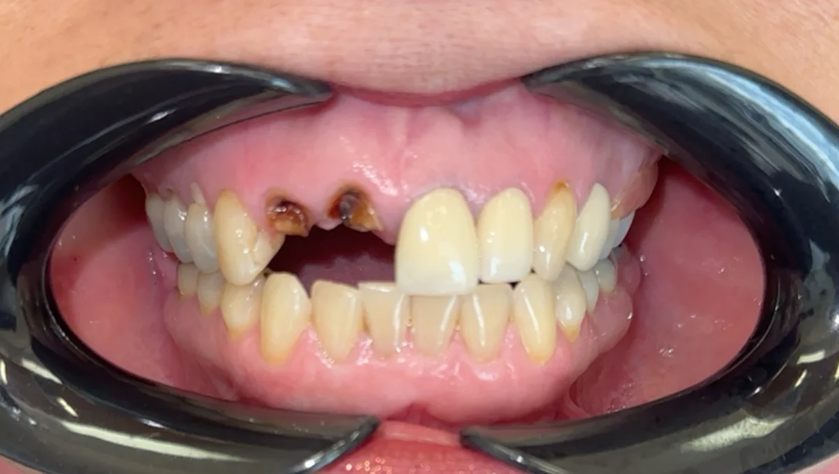 Before — real smile transformation at Muse Dental Studio