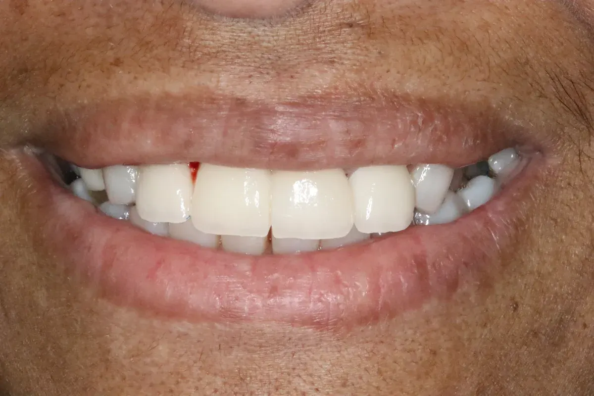 After — real smile transformation at Muse Dental Studio