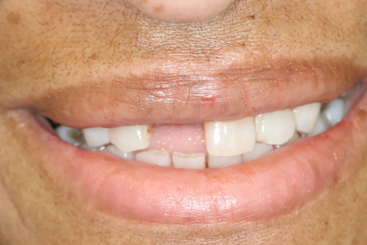 Before — real smile transformation at Muse Dental Studio
