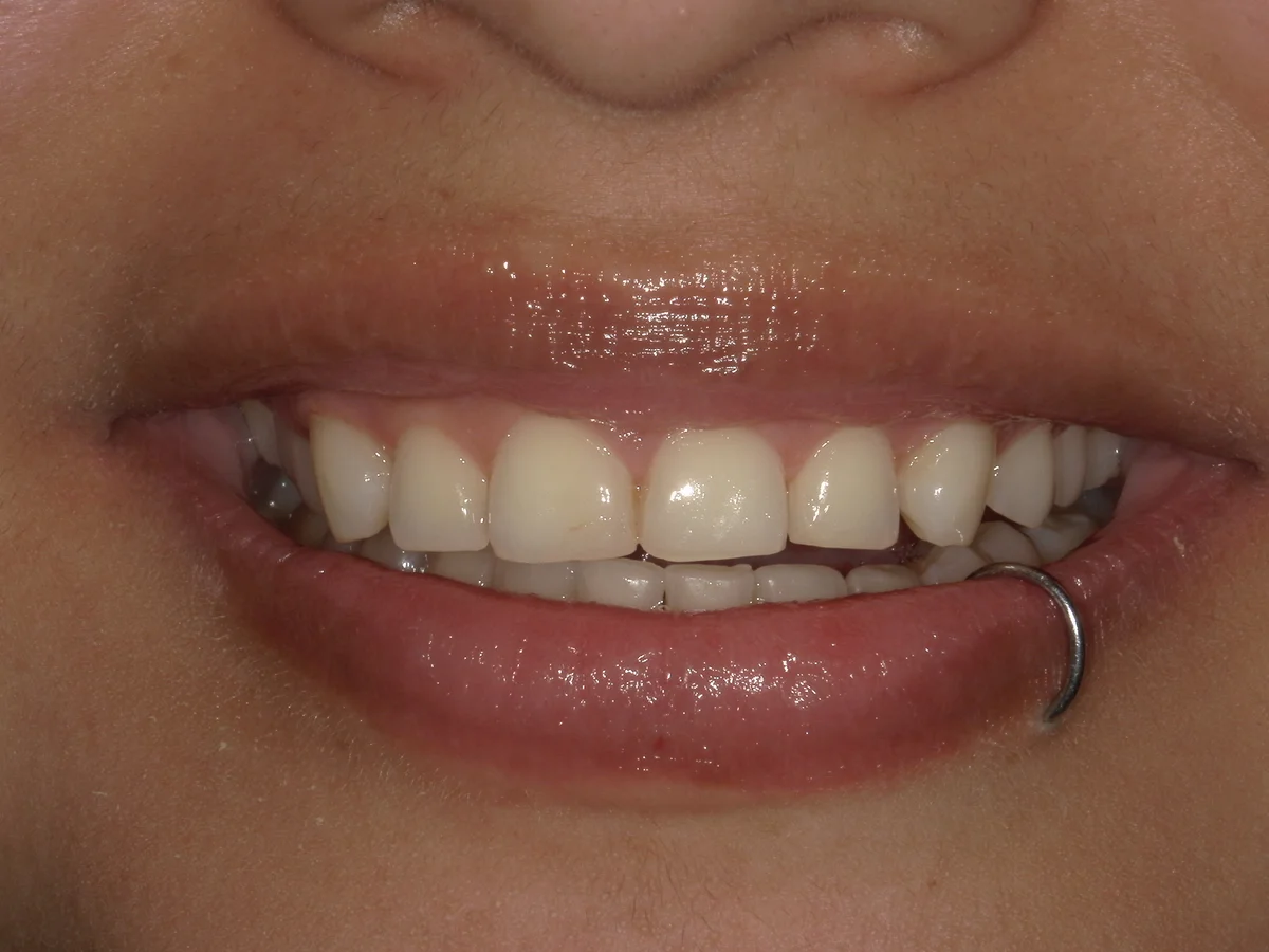 After — real smile transformation at Muse Dental Studio