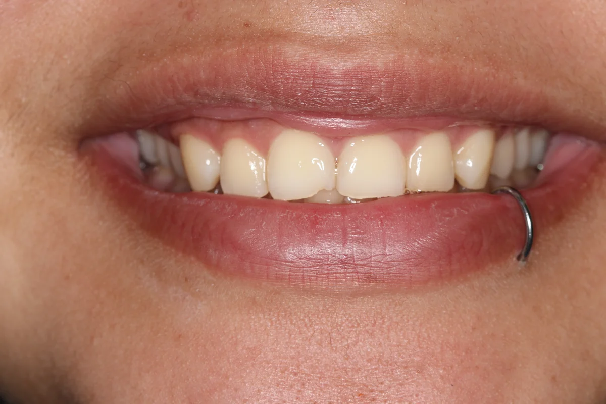 Before — real smile transformation at Muse Dental Studio