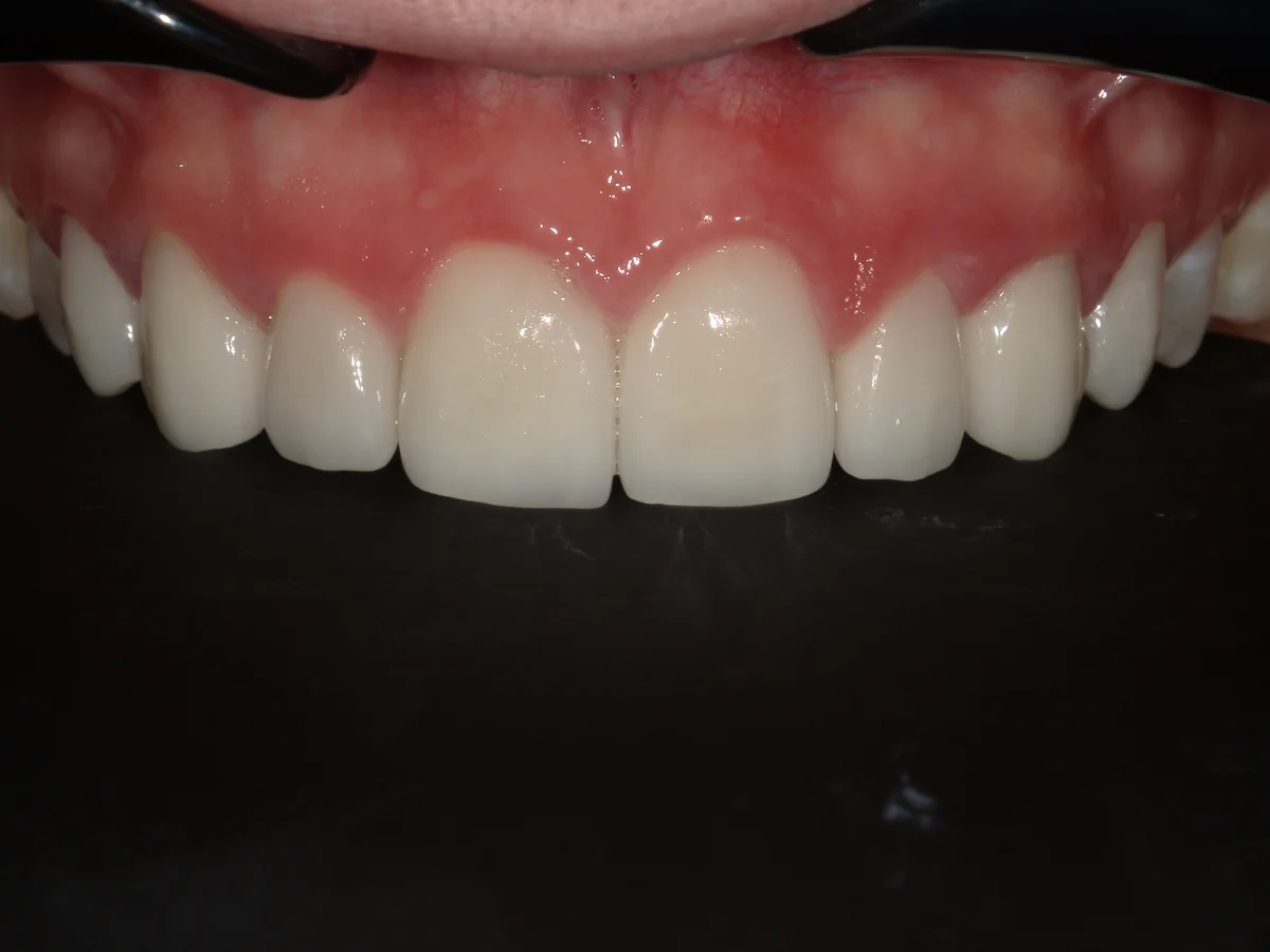 After — real smile transformation at Muse Dental Studio