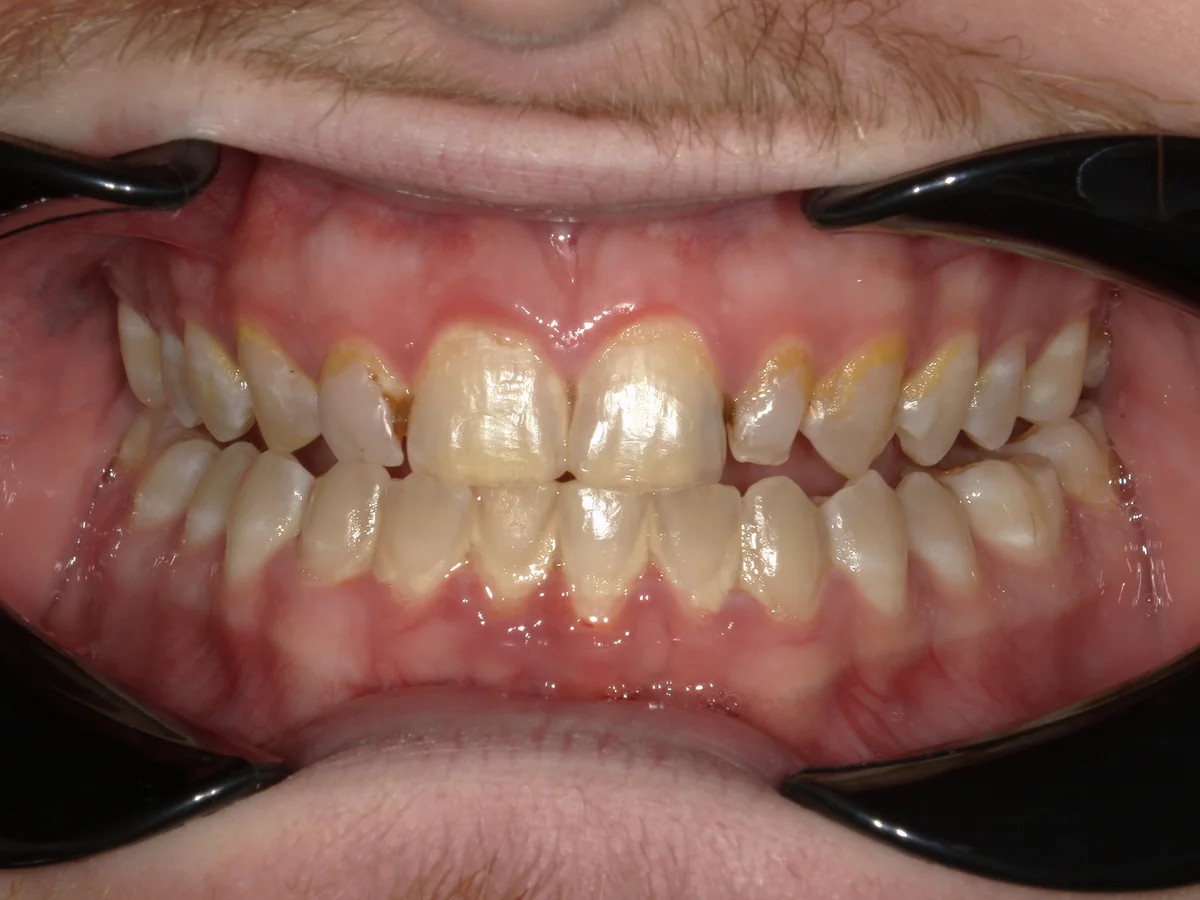 Before — real smile transformation at Muse Dental Studio