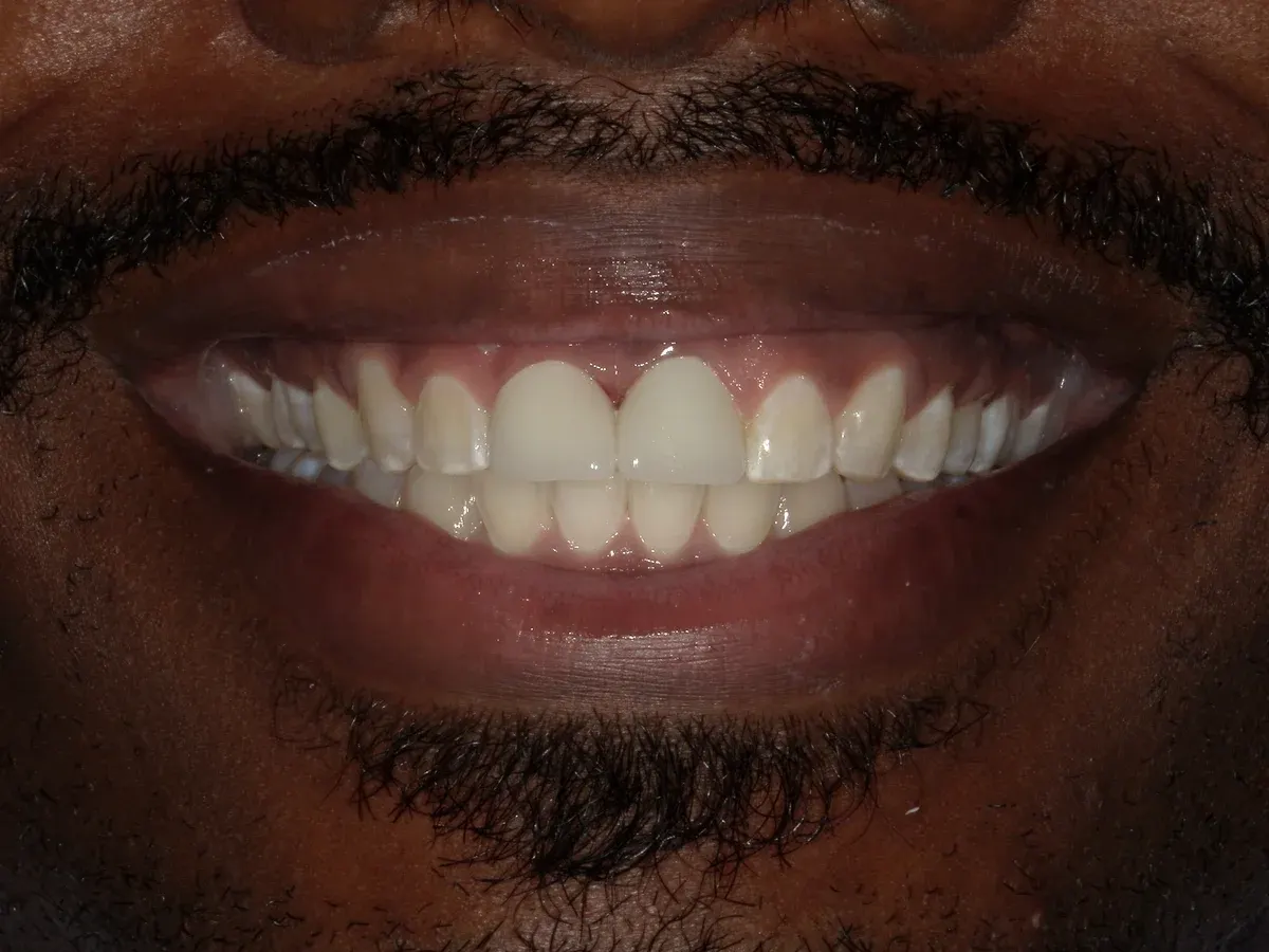After — real smile transformation at Muse Dental Studio