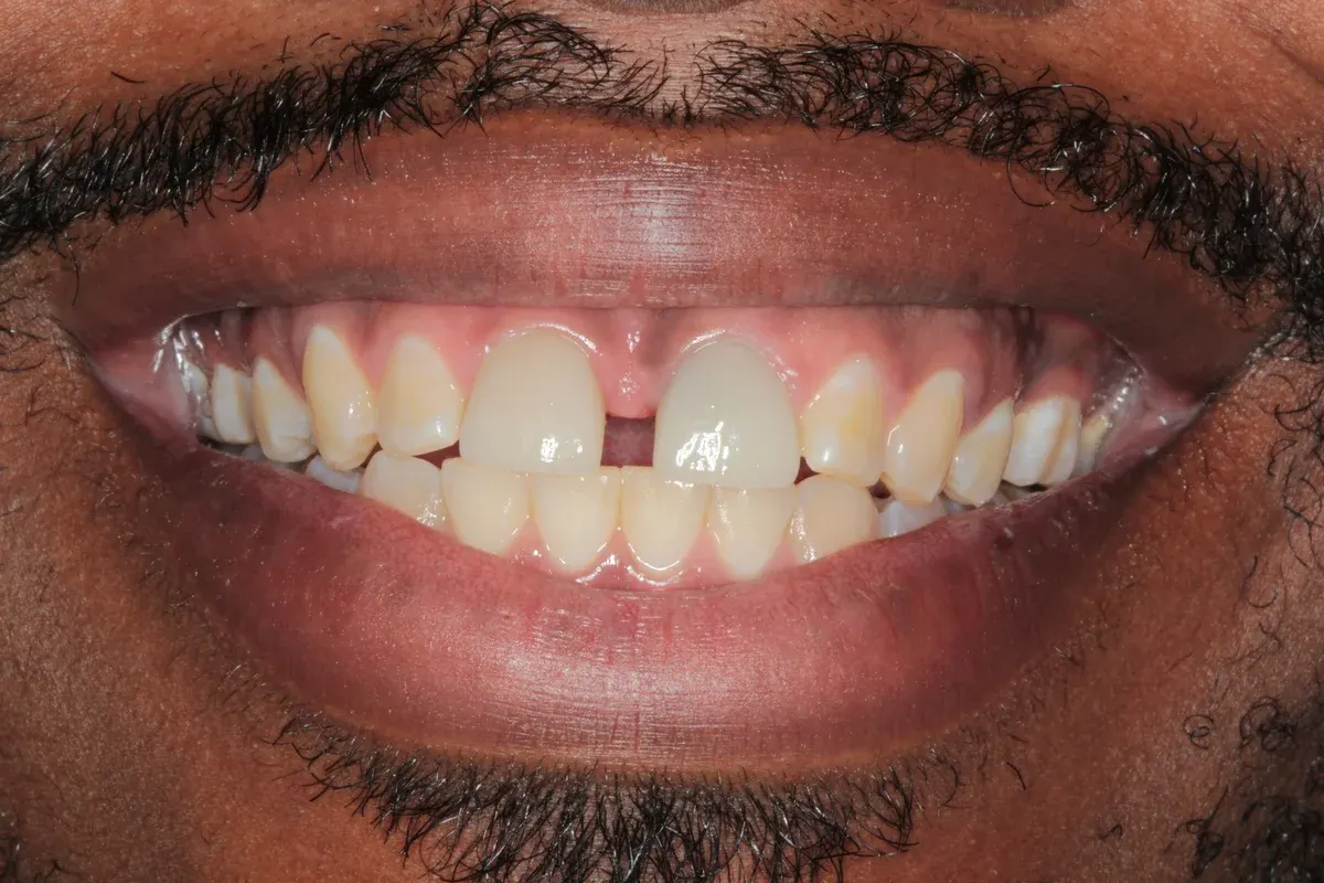 Before — real smile transformation at Muse Dental Studio