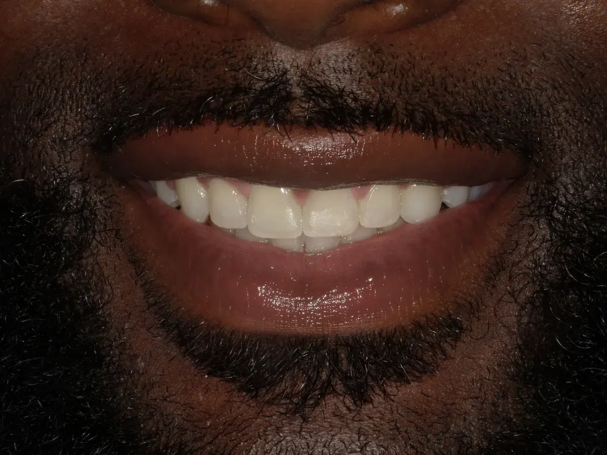 After — real smile transformation at Muse Dental Studio