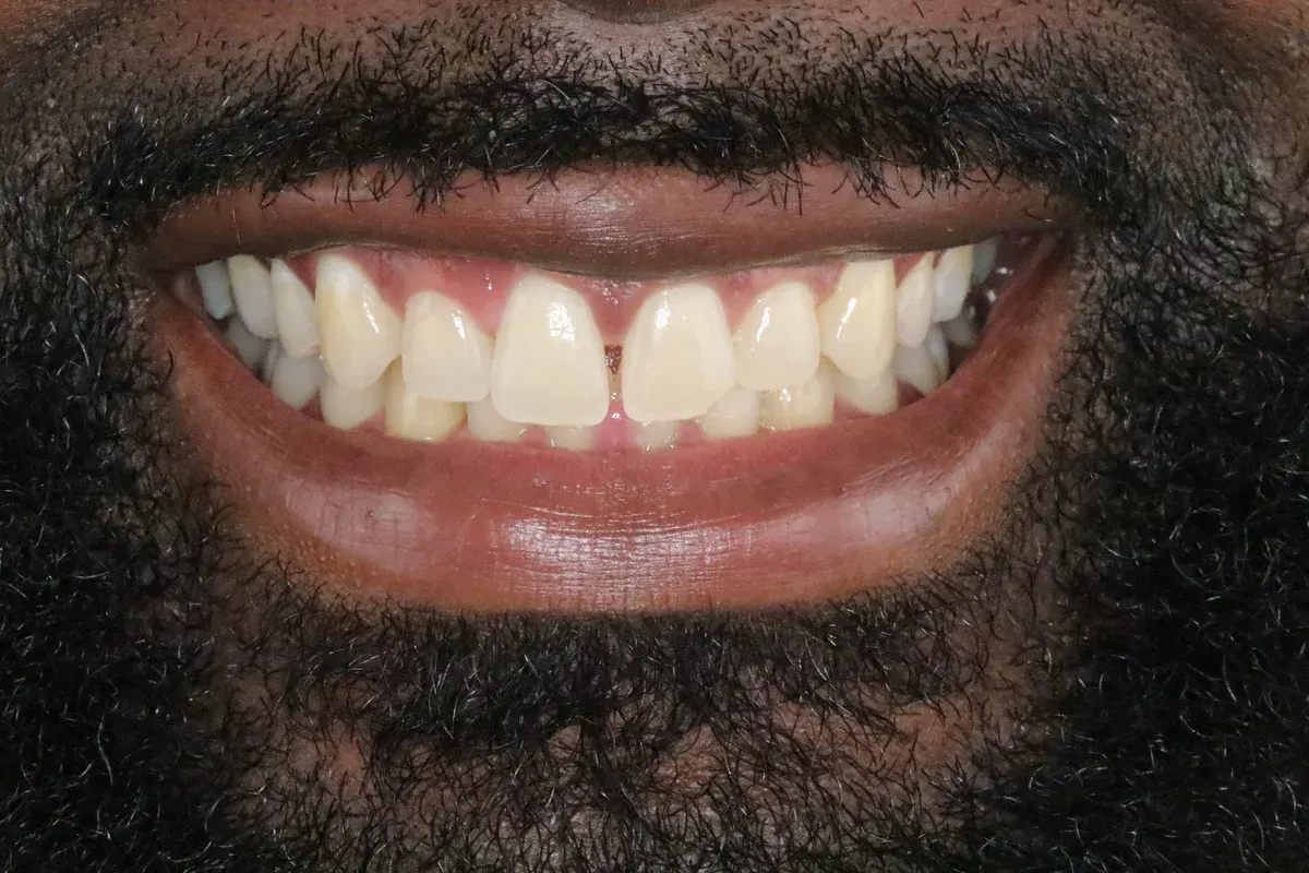 Before — real smile transformation at Muse Dental Studio