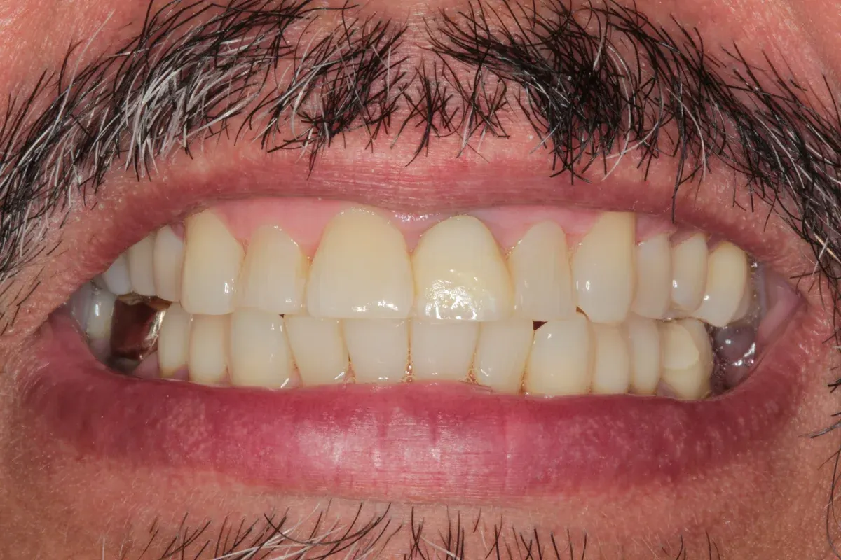 After — real smile transformation at Muse Dental Studio