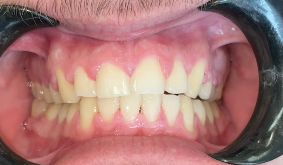After — real smile transformation at Muse Dental Studio