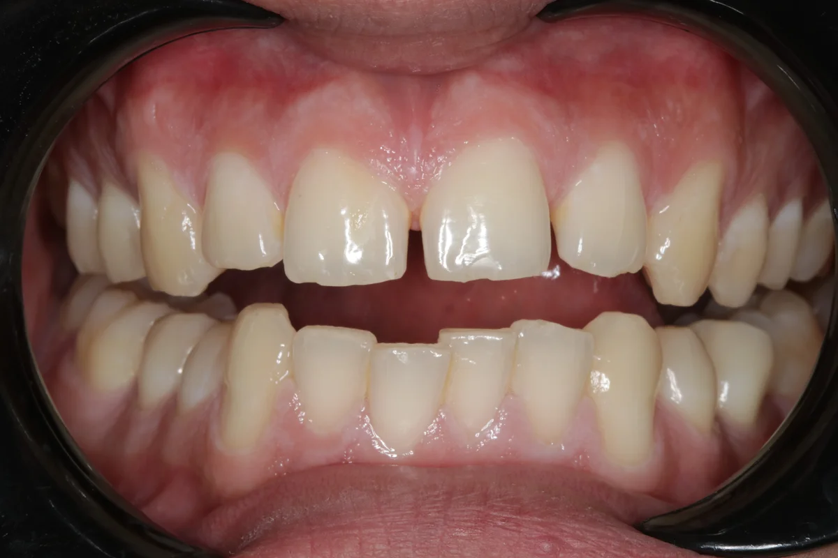 Before — real smile transformation at Muse Dental Studio