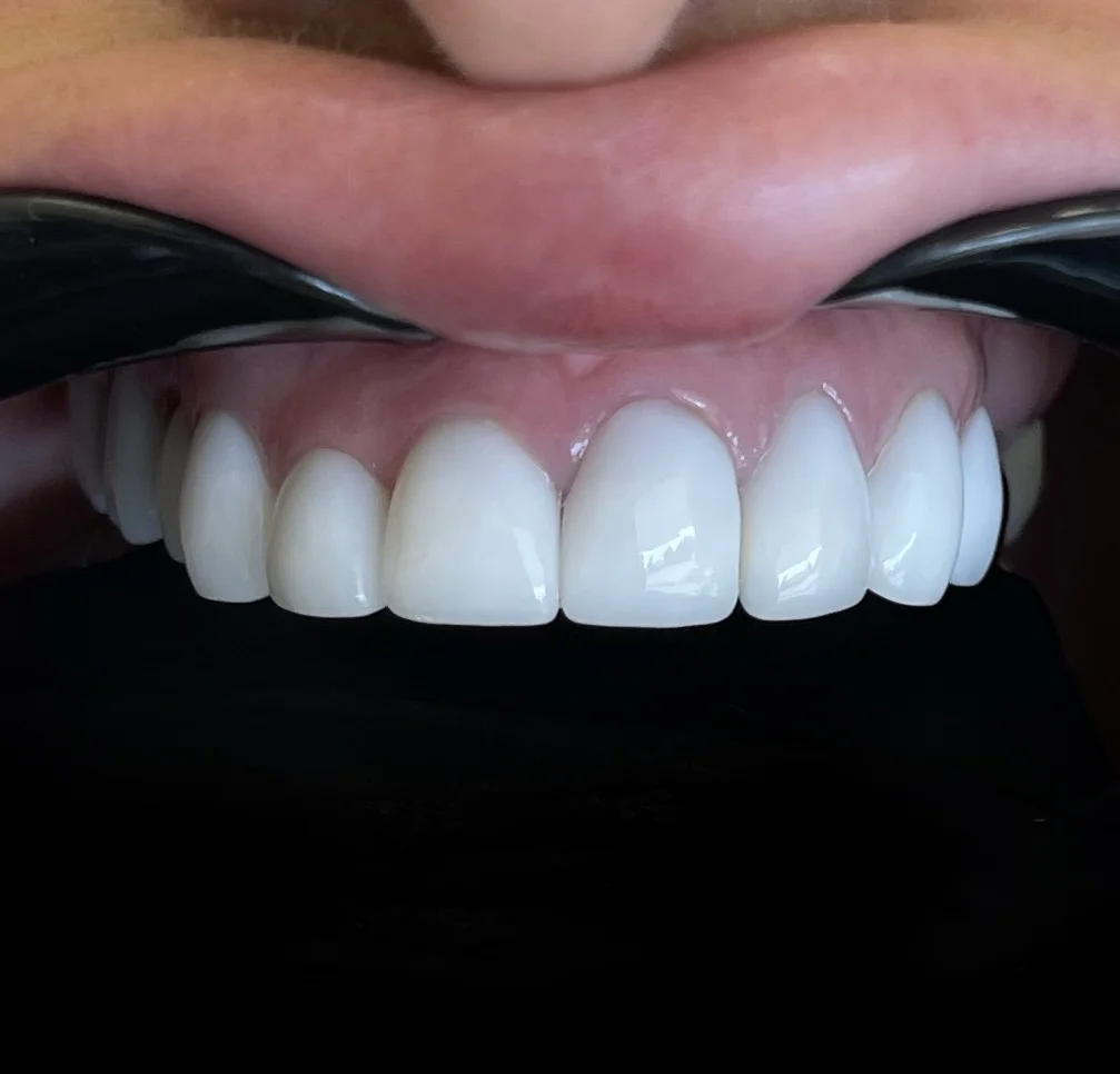 After — real smile transformation at Muse Dental Studio