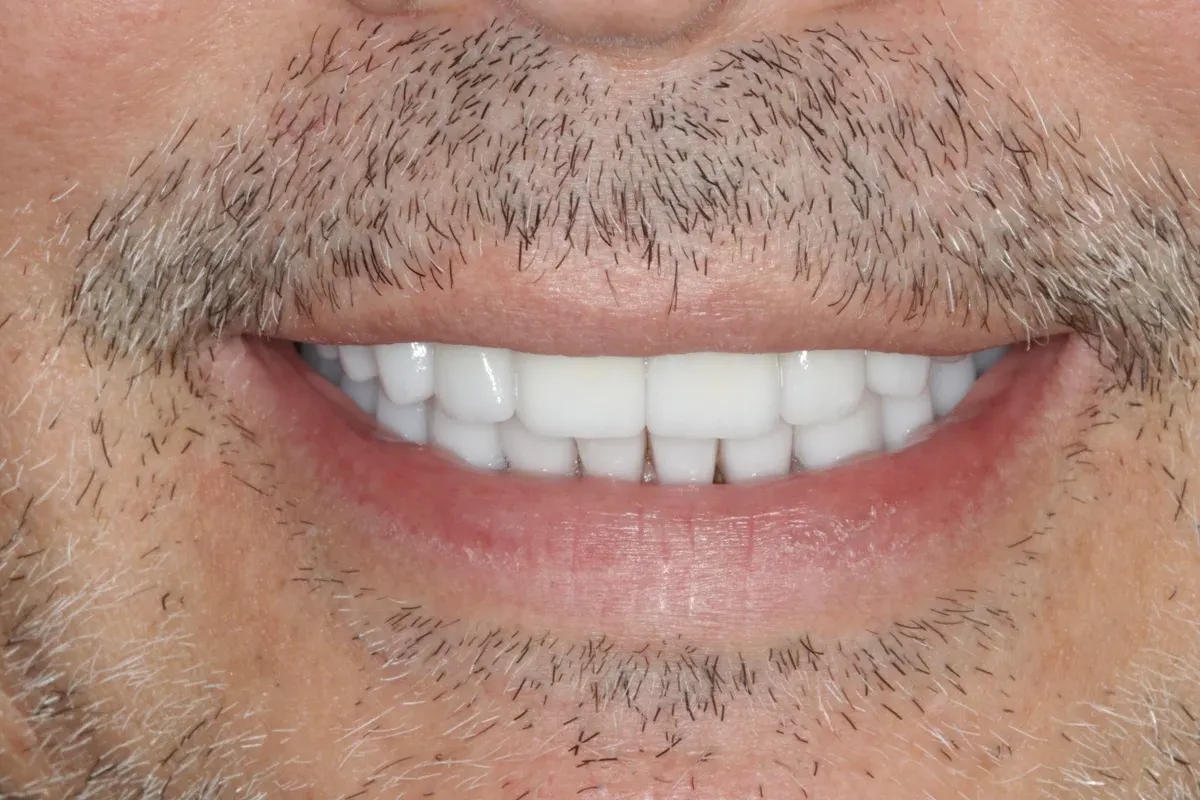 After — real smile transformation at Muse Dental Studio
