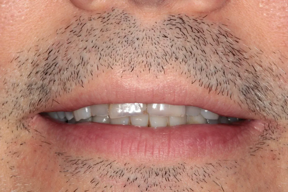 Before — real smile transformation at Muse Dental Studio