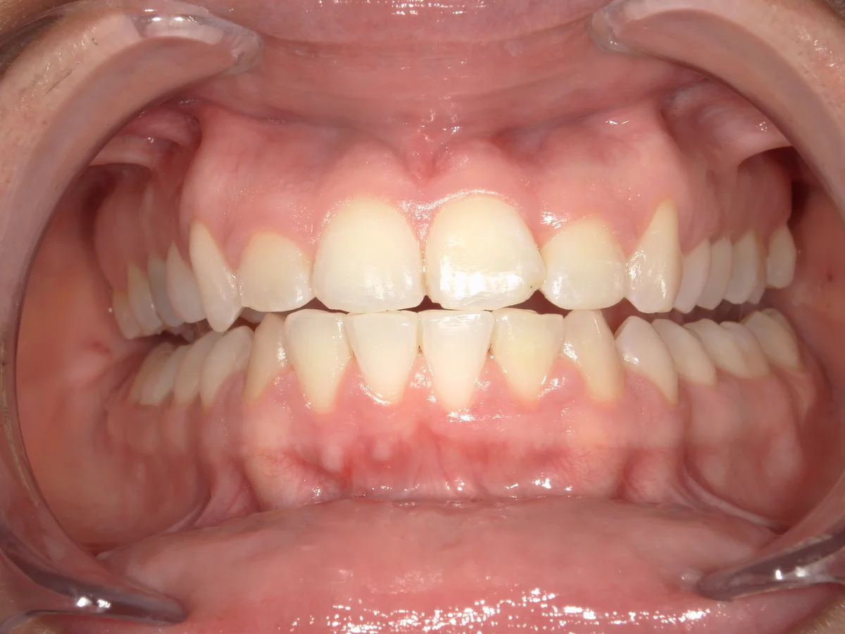 After — real smile transformation at Muse Dental Studio