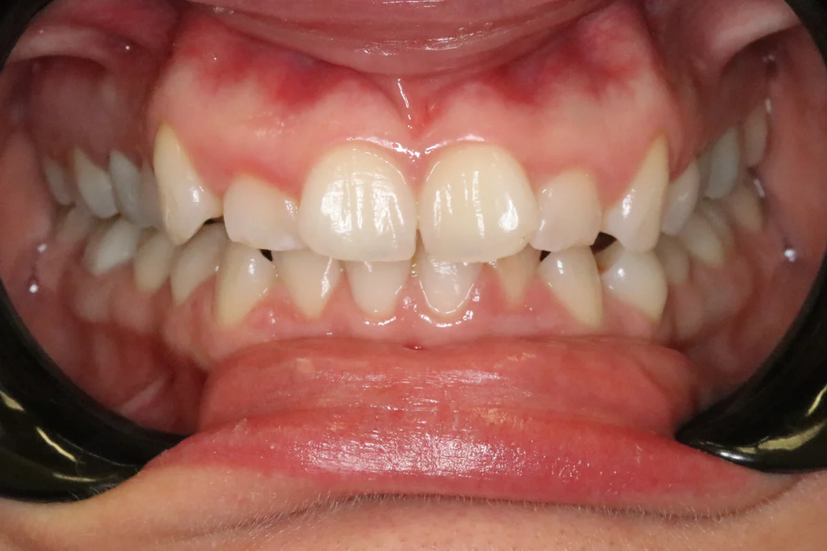 Before — real smile transformation at Muse Dental Studio