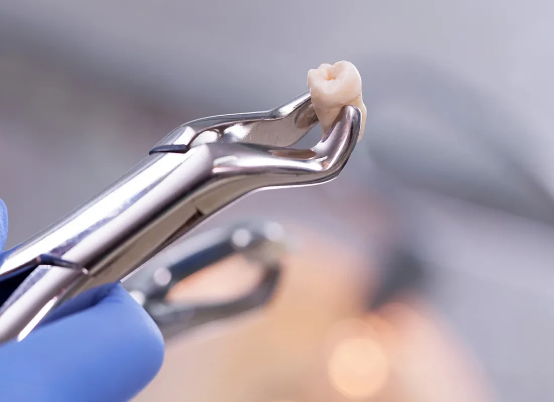 What is Teeth Extraction